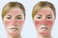 Làm thế nào để không bị đỏ mặt khi uống rượu?