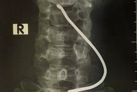 Hình ảnh chiếc thanh sắt cắm vào cổ bệnh nhân. (Ảnh: PV/Vietnam+).