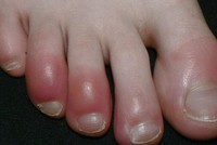 Một bệnh nhân mắc chứng cước ngón chân. Ảnh: Wikipedia.