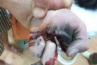 Bàn tay của Hải bị nát do điện thoại phát nổ khi vừa sạc điện thoại vừa chơi game. (Ảnh: TTXVN phát).