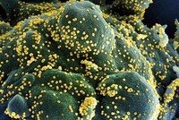 Một tế bào (xanh dương/xanh lục) bị nhiễm nặng các hạt virus SARS-CoV-2 (màu vàng), được phân lập từ mẫu của bệnh nhân COVID-19. (Ảnh: AFP/TTXVN).