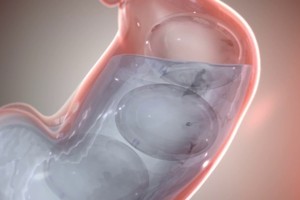 Obalon, phát minh đặc biệt giúp giảm cân ấn tượng