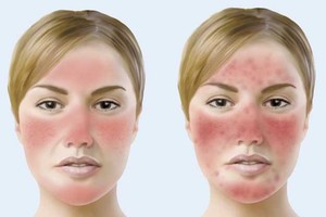 Làm thế nào để không bị đỏ mặt khi uống rượu?