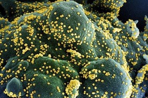 Một tế bào (xanh dương/xanh lục) bị nhiễm nặng các hạt virus SARS-CoV-2 (màu vàng), được phân lập từ mẫu của bệnh nhân COVID-19. (Ảnh: AFP/TTXVN).