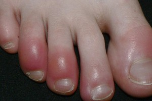 Một bệnh nhân mắc chứng cước ngón chân. Ảnh: Wikipedia.