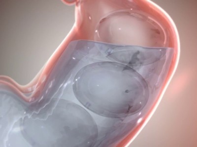 Obalon, phát minh đặc biệt giúp giảm cân ấn tượng