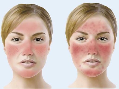 Làm thế nào để không bị đỏ mặt khi uống rượu?