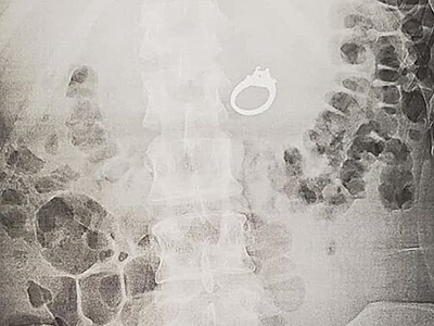 Chiếc nhẫn trong cơ thể Jenna Evans. Ảnh: Nbcsandiego.