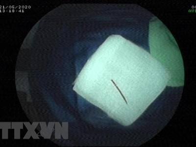 Đoạn tăm xỉa răng được nội soi gắp ra từ hậu môn bệnh nhân T. (Ảnh: TTXVN phát).