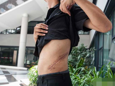 Vết mổ thận 7 năm trước của Tiểu Vương. Ảnh Sina