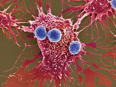 Nghiên cứu mới: Tiêu diệt ung thư bằng...“bom vi khuẩn“