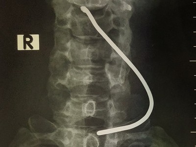 Hình ảnh chiếc thanh sắt cắm vào cổ bệnh nhân. (Ảnh: PV/Vietnam+).