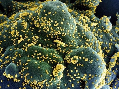 Một tế bào (xanh dương/xanh lục) bị nhiễm nặng các hạt virus SARS-CoV-2 (màu vàng), được phân lập từ mẫu của bệnh nhân COVID-19. (Ảnh: AFP/TTXVN).