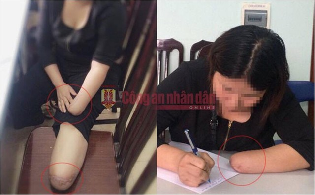 Phẫu thuật nối không thành công, N phải dùng tay giả. (Báo Công an Nhân dân). Phẫu thuật nối không thành công, N phải dùng tay giả. (Báo Công an Nhân dân).