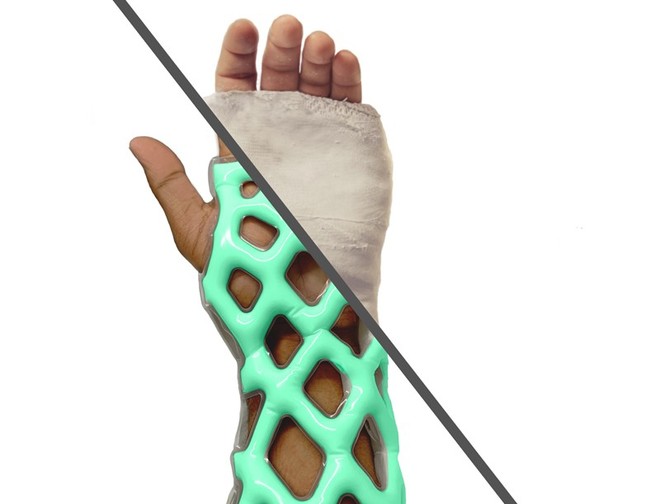 Khuôn bó bột kiểu mới không gây ngứa, không mùi, không cần cắt bằng cưa