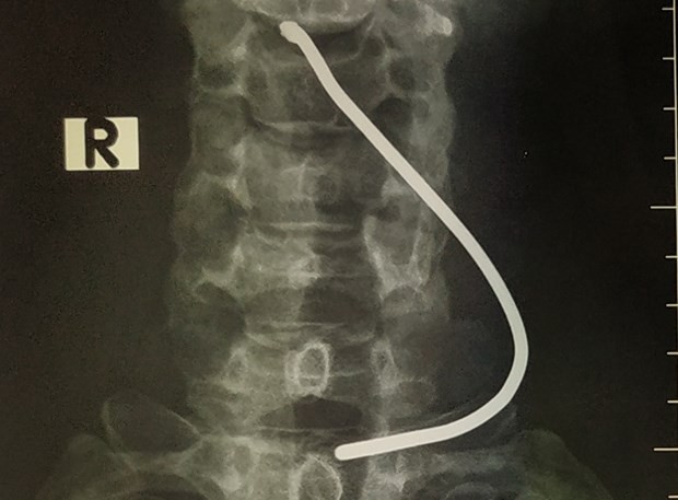 Hình ảnh chiếc thanh sắt cắm vào cổ bệnh nhân. (Ảnh: PV/Vietnam+).